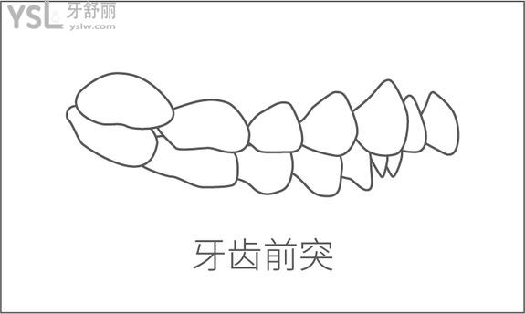 牙齒前突