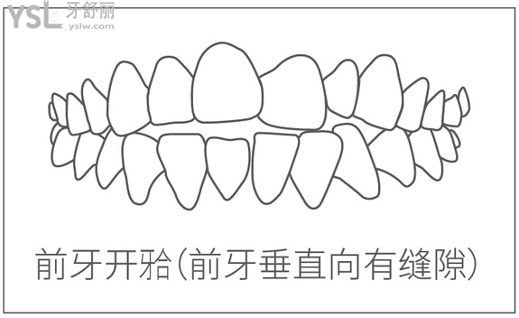 前牙開(kāi)合