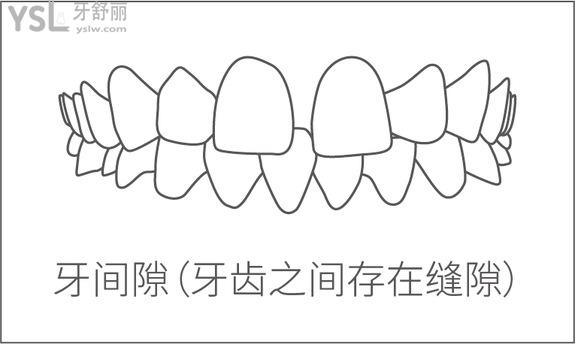 牙間隙