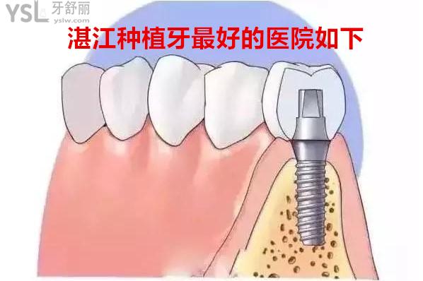 湛江種植牙<span style=