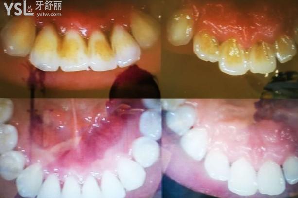銀川諾貝爾口腔顧客洗牙前后對(duì)比