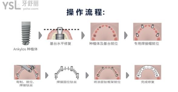 半口速齒種植牙操作流程