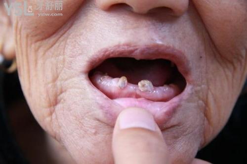 你問我答：牙齒缺失久了還能種植嗎（牙齒缺失10年了還可以修復(fù)嗎）