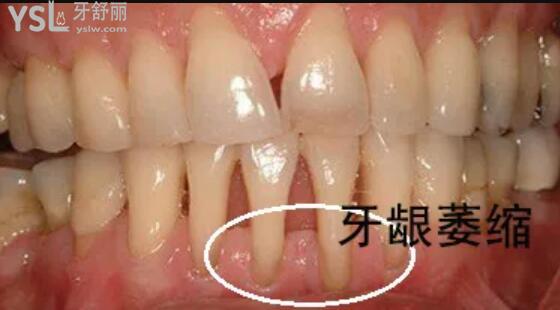 牙齦萎縮**圖