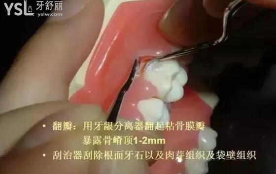 牙周翻瓣術(shù)