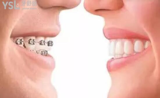 成人牙齒矯正有用嗎