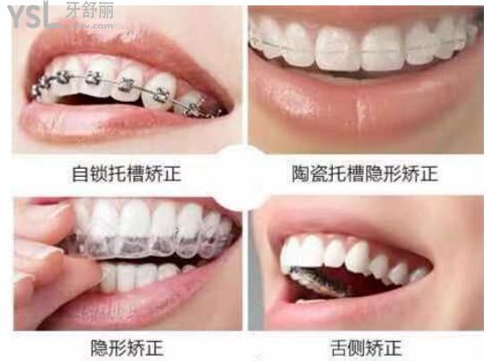 牙齒矯正的幾種方式