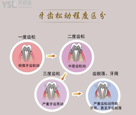 牙齒松動程度區(qū)分