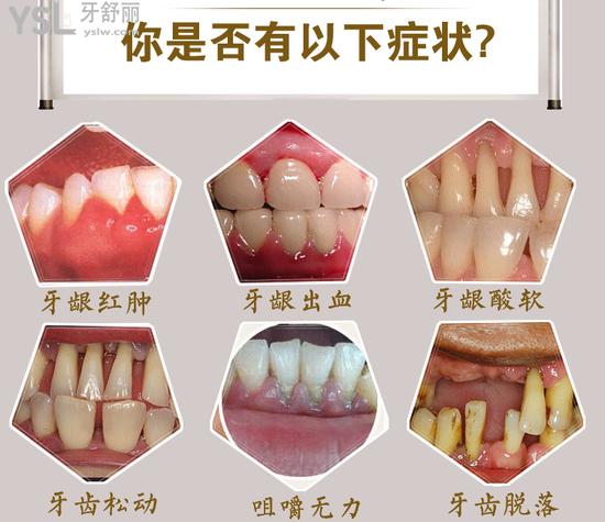 牙齒松動牙齦萎縮癥狀
