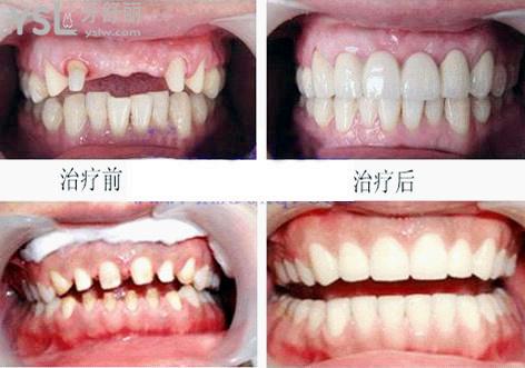 全瓷牙治療成效參考