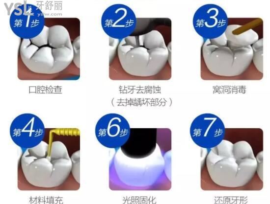 補牙流程圖