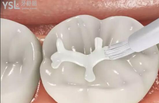 樹脂材料補牙