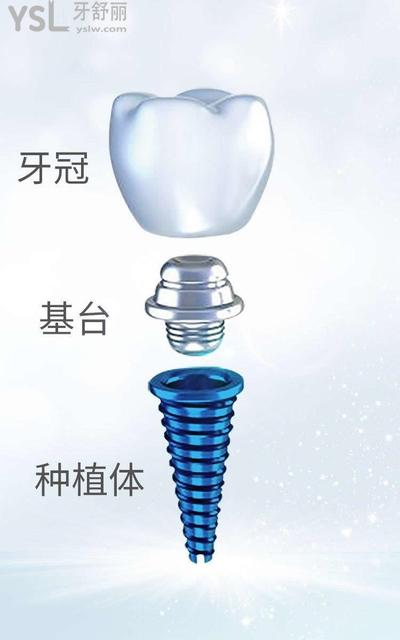 種植牙組成