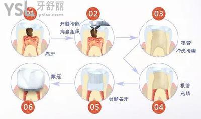 根管治療1