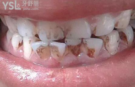 牙齒不好是怎么回事
