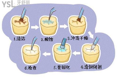 補牙的流程及步驟是什么？