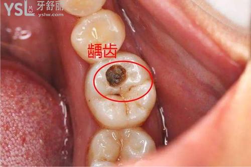 補牙的流程及步驟是什么？過程超簡單