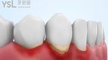 得了牙周炎 要怎么治療呢?