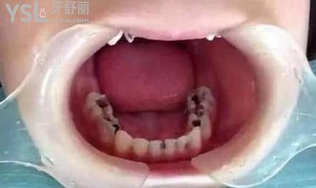 我的一顆大牙爛掉了一半了,應(yīng)該怎么辦？