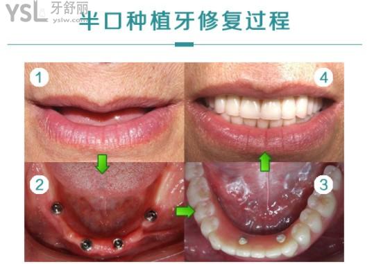 半口種植牙修復(fù)過(guò)程