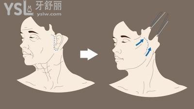 拉皮手術(shù)怎么樣