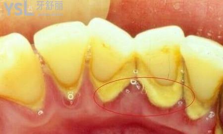 牙結(jié)石清除價(jià)格是多少?