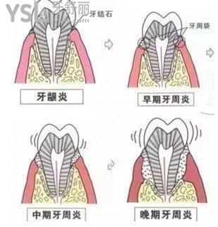 老牙松動了好疼怎么辦