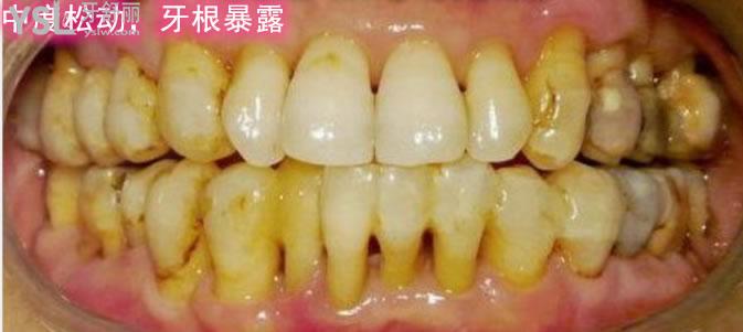 老牙松動了好疼怎么辦