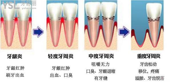 老牙松動了好疼怎么辦