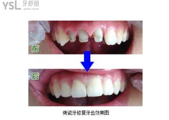 烤瓷牙修復(fù)前后對(duì)比圖