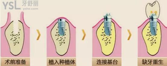韓國種植體的基臺是什么材料