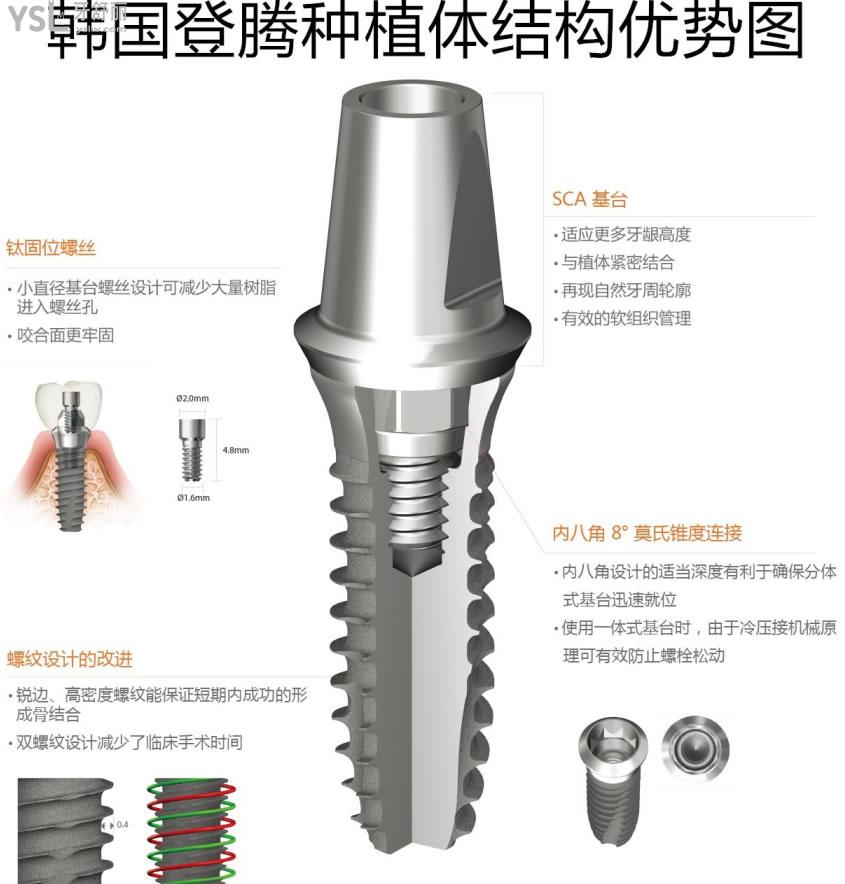 韓國種植體的基臺是什么材料