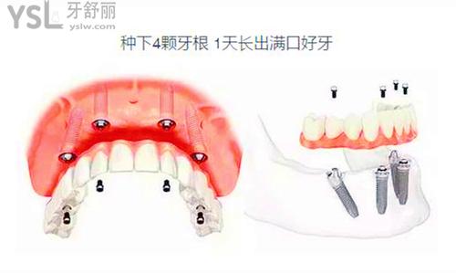 種植牙即拔即種好嗎？2個因素決定