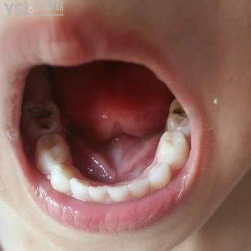 治療蛀牙的方法和步驟有什么注意的？