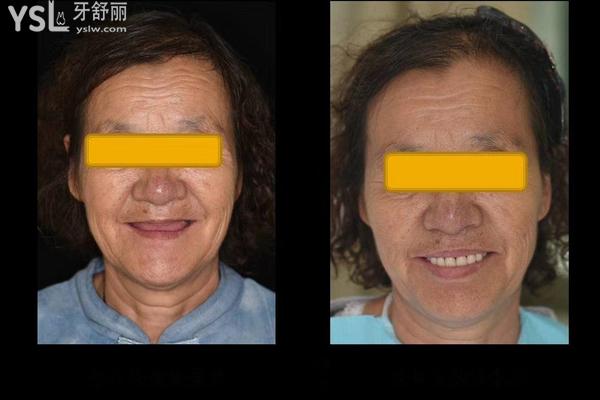 全口無牙怎么種植牙，是一顆一顆嗎？來看答案