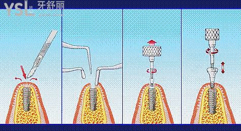 全口無牙怎么種植牙，是一顆一顆嗎？