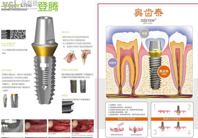 種假牙是韓國好還是瑞士的好
