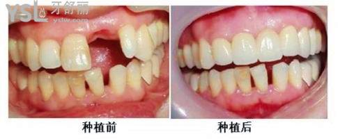 種植牙是真牙還是假牙？