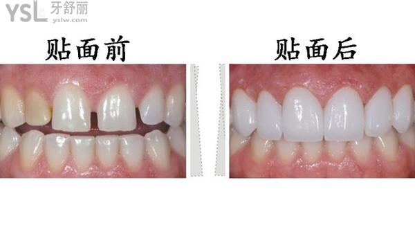 貼面需要磨牙嗎