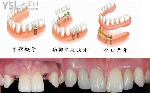 公布2021做一顆種植牙多少錢