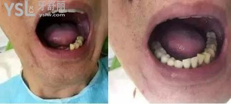 種植牙后可以吃東西嗎？