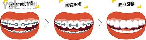 牙齒隱形矯正器有用嗎