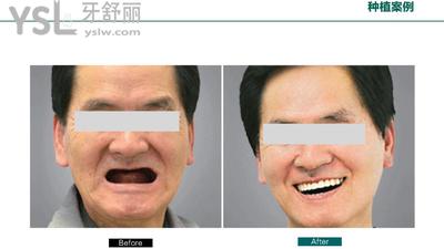 穿顴種植是什么