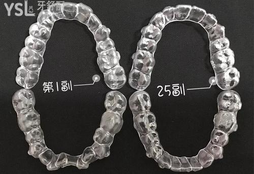 隱形矯正牙齒的過程