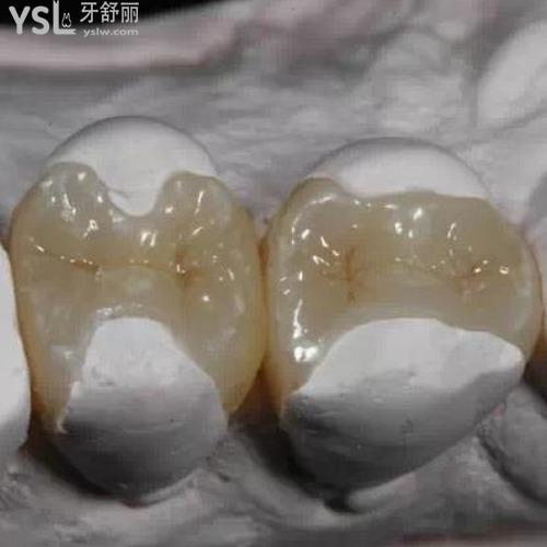 補牙材料哪種好？