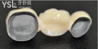 鈷鉻內(nèi)冠烤瓷牙