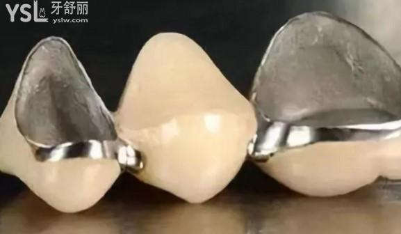 鎳鉻合金烤瓷牙