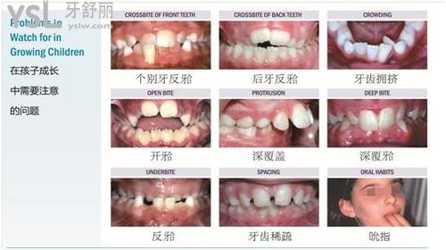 兒童mrc矯正器適合的年齡和情況
