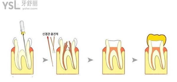 根管治療過(guò)程