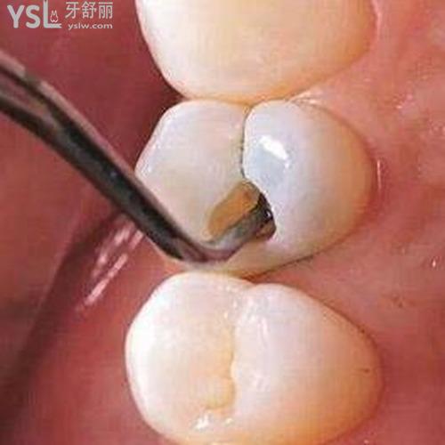 蛀牙就剩牙根了好拔嗎？